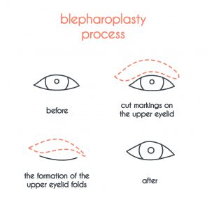 Blepharoplasty procedure Eyelid Surgery Glastonbury