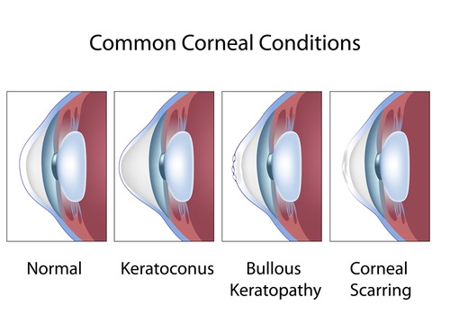 Common Cornea Conditions Diagram