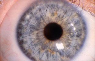 Corneal Transplant Example 